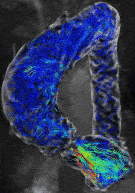 1754400847324323.gif 2_1AortaMRI_压缩.gif